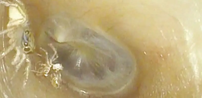 Врачи обнаружили паука, сбросившего старую шкурку внутри уха женщины