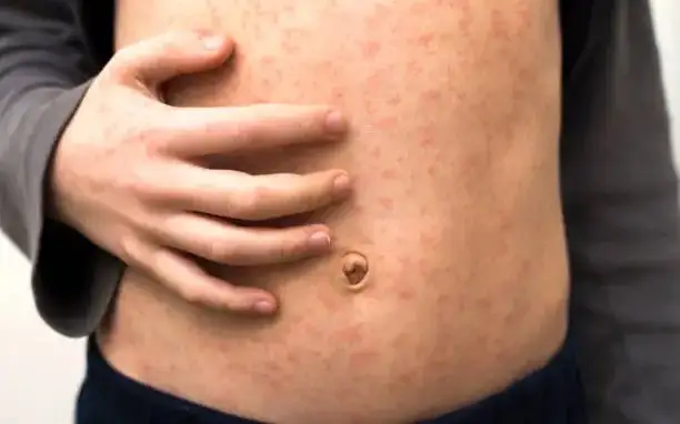 Шығыс Қазақстанда 63 бала қызылша жұқтырған