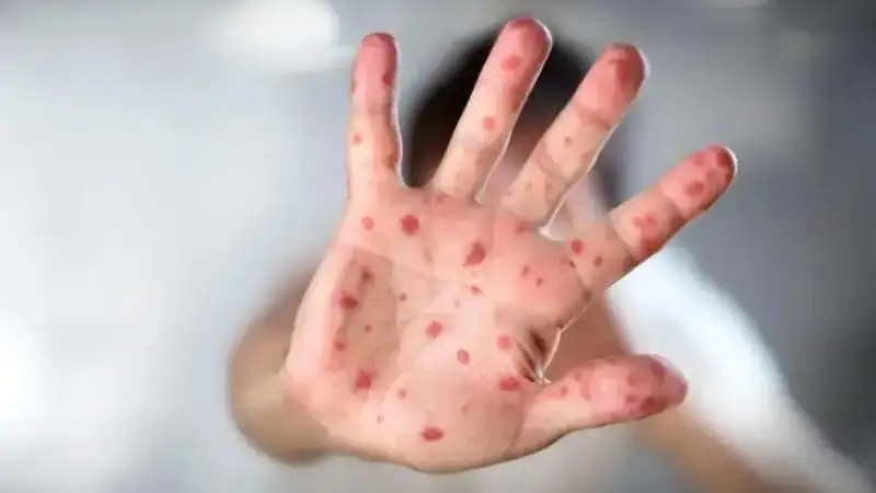 Measles situation unstable in Astana, authorities say