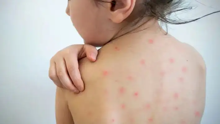 E Kazakhstan confirms 87 measles cases