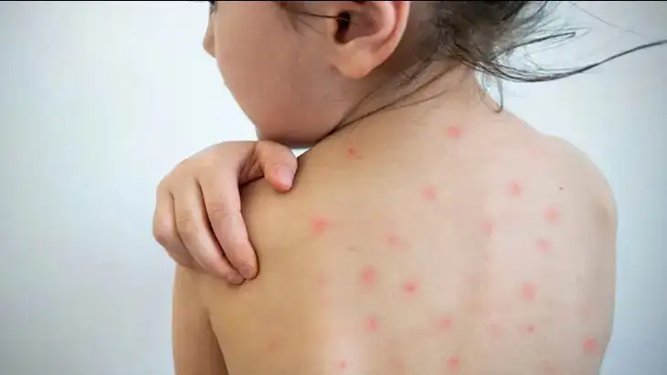 Measles