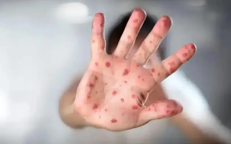 measles