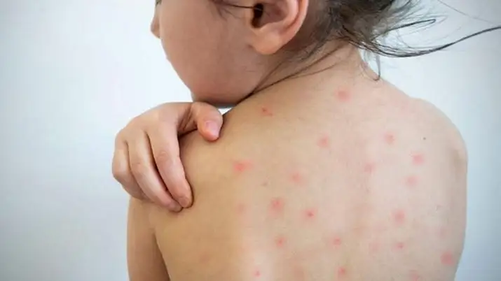 Kazakhstan stands among Top-3 countries with the highest number of measles cases