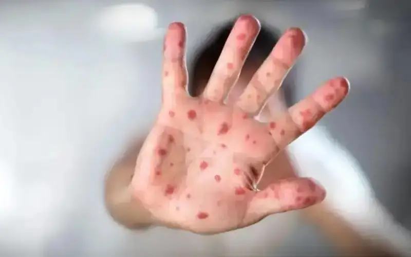 Measles cases