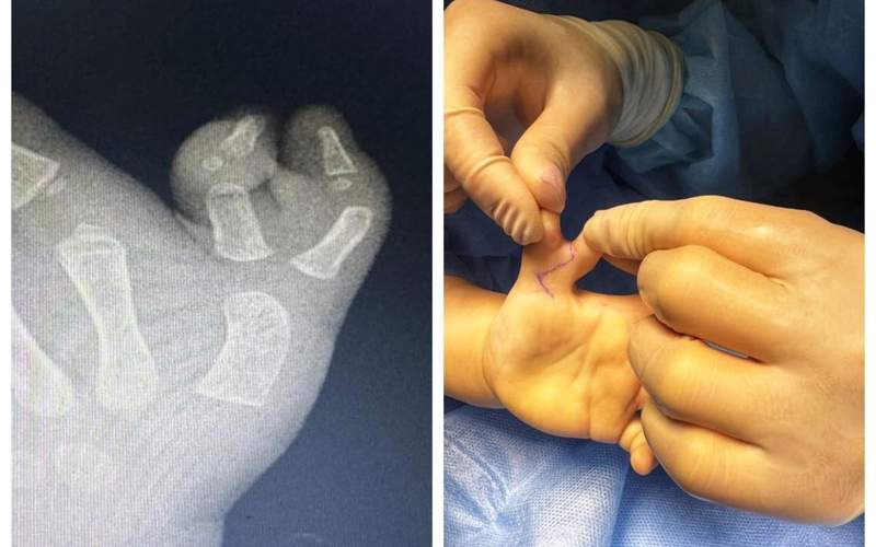 удалили шестой палец