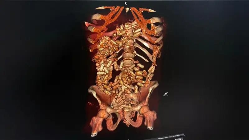 есірткі жұтқан