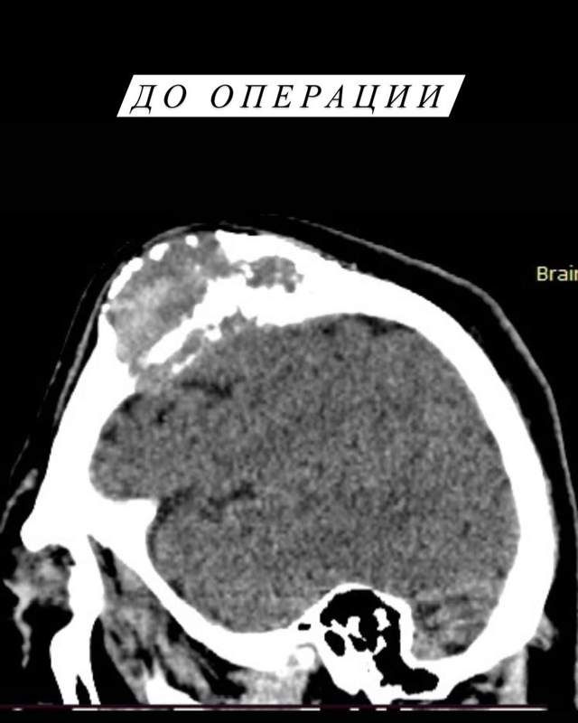 Более 700 операций по ОСМС провели в астанинском Национальном центре нейрохирургии