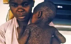 корь в Нигерии