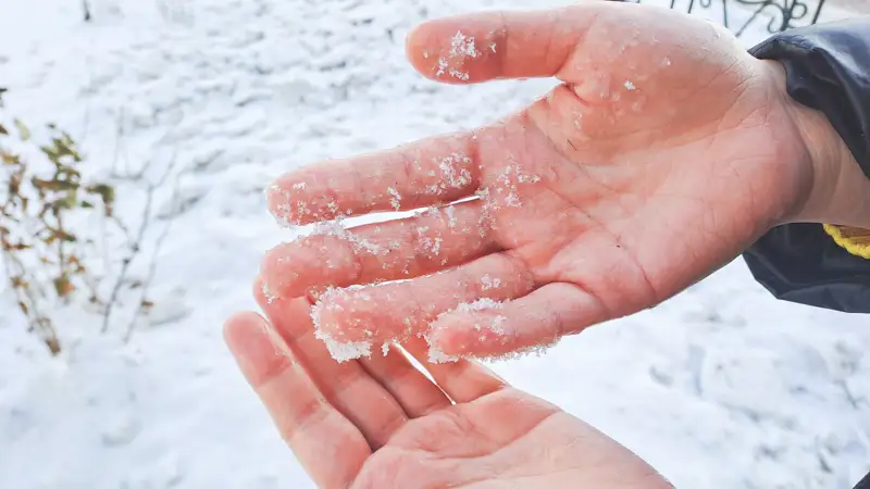 Обморожение рук 