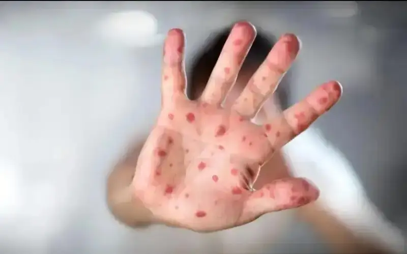 Over 3000 measles cases recorded in Almaty