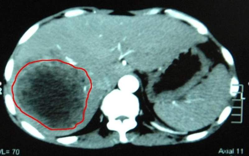 Giant tumor removed at Zhambyl Center for Oncology and Surgery