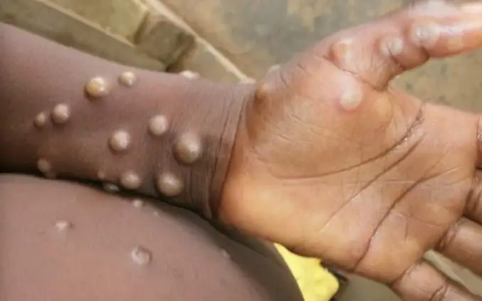 International Red Cross ramps up mpox response in Africa as disease spreads