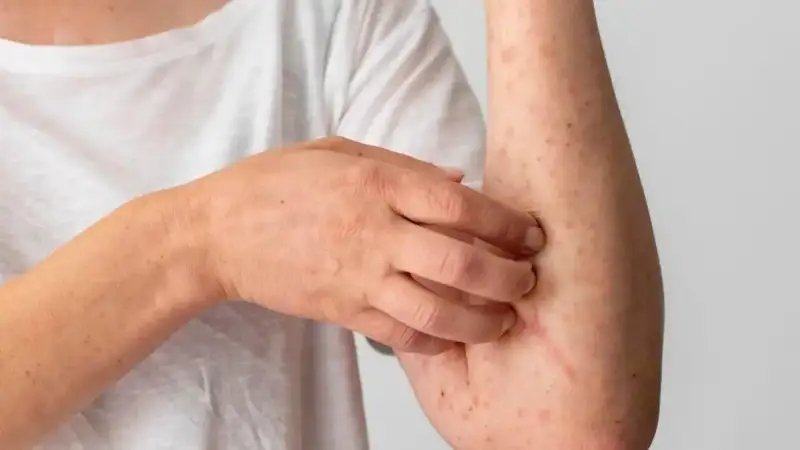 оспа обезьян