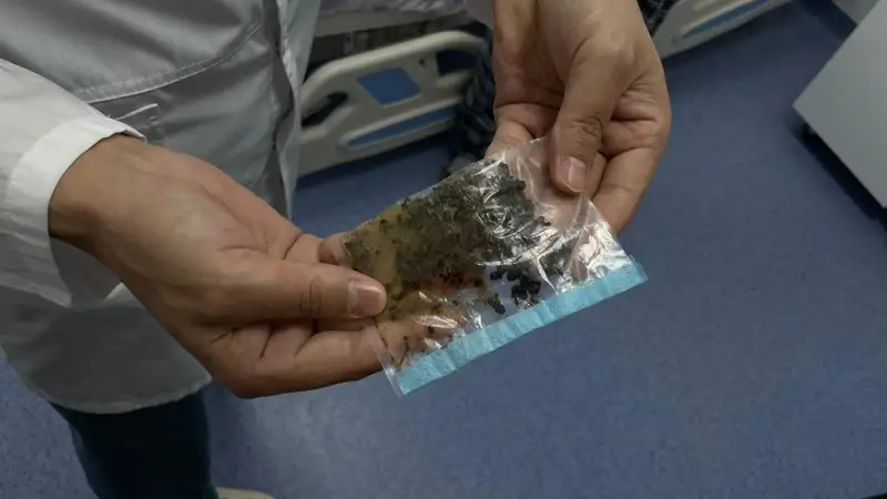 более 50 камней удалили из желчного пузыря