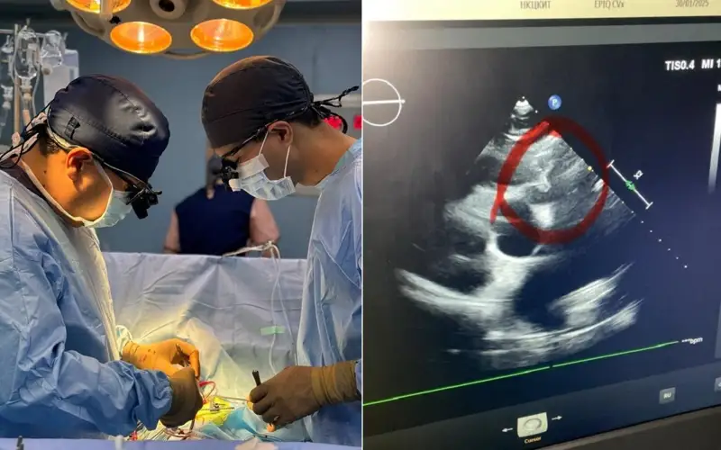 Жамбылские хирурги создали новый клапан легочной артерии из ткани сердца