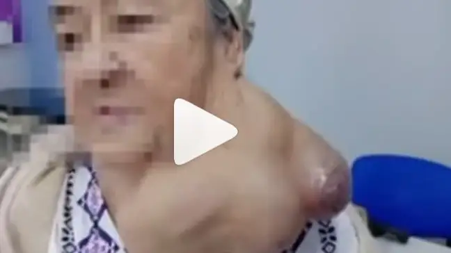  Ақтаулық дәрігерлер науқастың мойынынан 1 келідей ісікті алып тастады