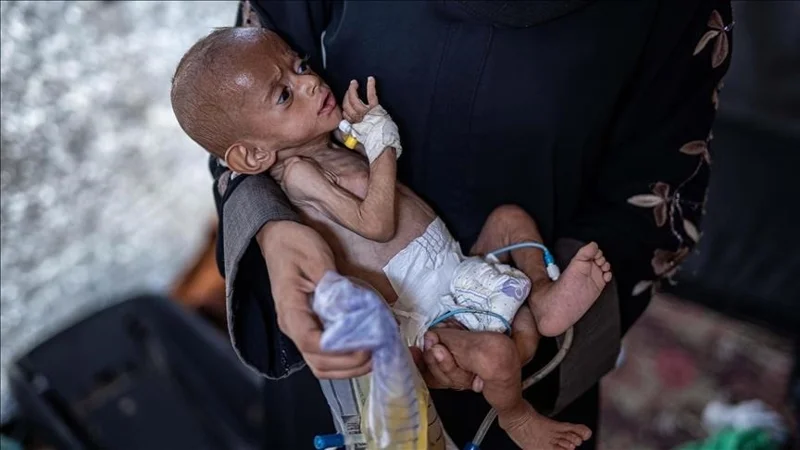 Газада 65 000-нан астам бала аштыққа байланысты пайда болған сырқатпен емделіп жатыр