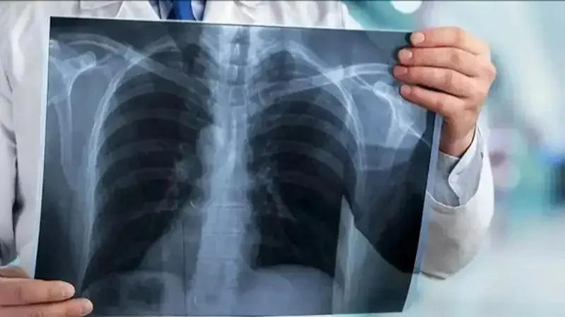Tuberculosis surge recorded in Kazakhstan’s Akmola region