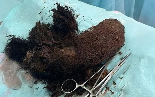 БҚО-да 13 жастағы қыздың асқазанынан 642 грамм шаш шықты