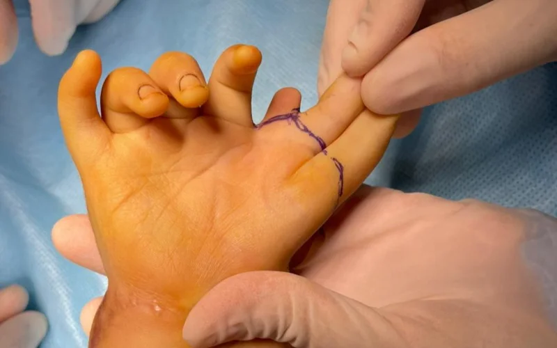 полифалангия