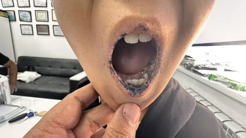 Қырғызстанда балаларда сирек кездесетін синдром анықталды