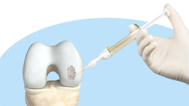 Cartilage lesions treatment