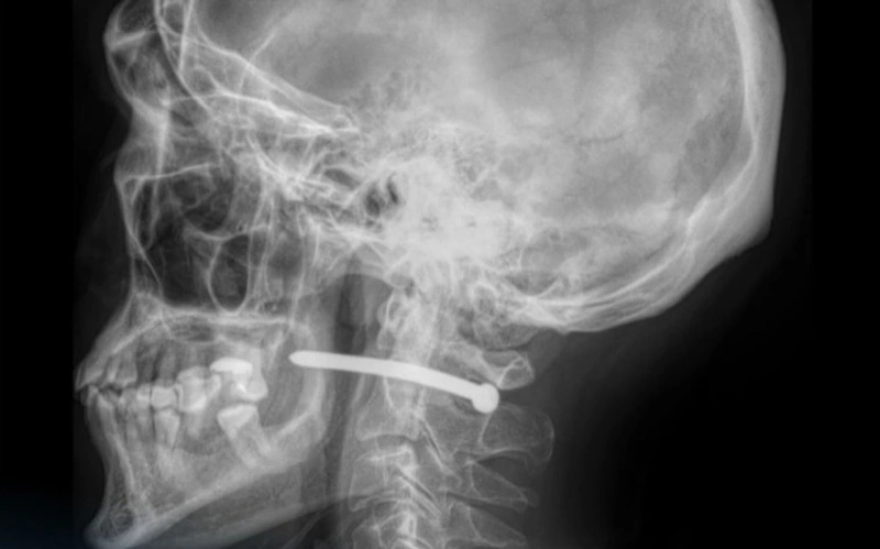 СҚО-да абайсызда пистолетпен басына шеге атылған ер адам аман қалды