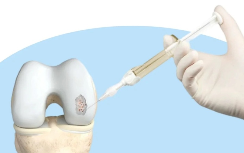 Collagen gel offers new hope for cartilage repair Collagen gel, cartilage repair, regenerative orthopedics