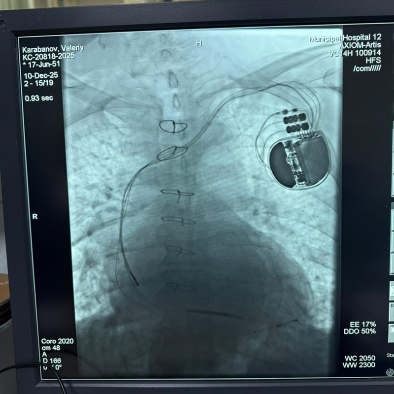 First implantation of device preventing sudden cardiac arrest performed in Almaty Implantation, device, sudden cardiac arrest, medicine, cardio