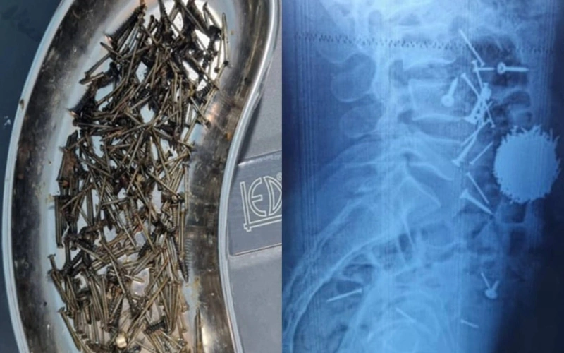 Өзбекстанда дәрігерлер науқастың асқазанынан 200 грамм шеге алып шықты