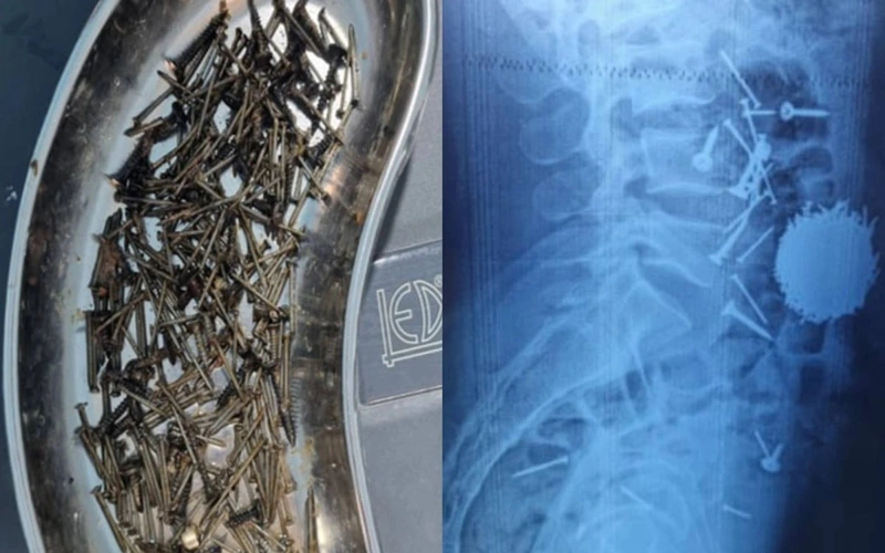 Самарқандда шифокорлар бемор қорнидан 200 грамм мих чиқариб олди