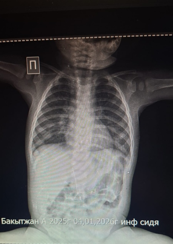 Иглу из брюшной полости младенца извлекли в Туркестане