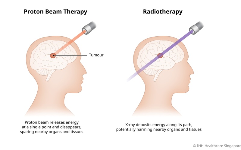 Proton therapy, cancer, health, healthcare, radiotherapy, X-ray