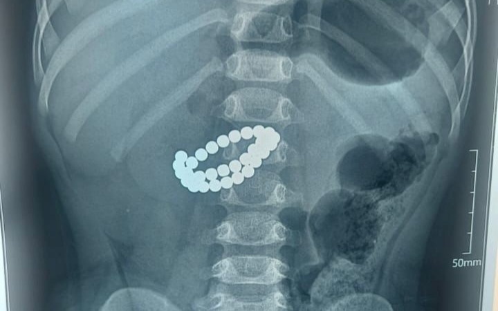 рентген, малыш проглотил магнит