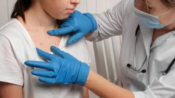 Scarlet fever cases rise 1.3-fold in Oral