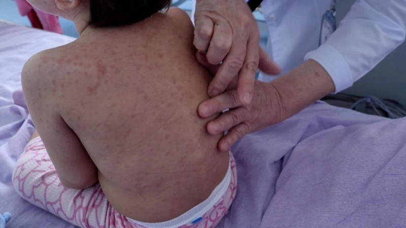 Measles hospitalizations soar in West Kazakhstan