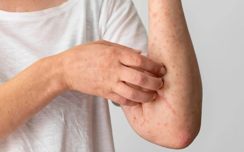 Measles cases halve in N Kazakhstan region