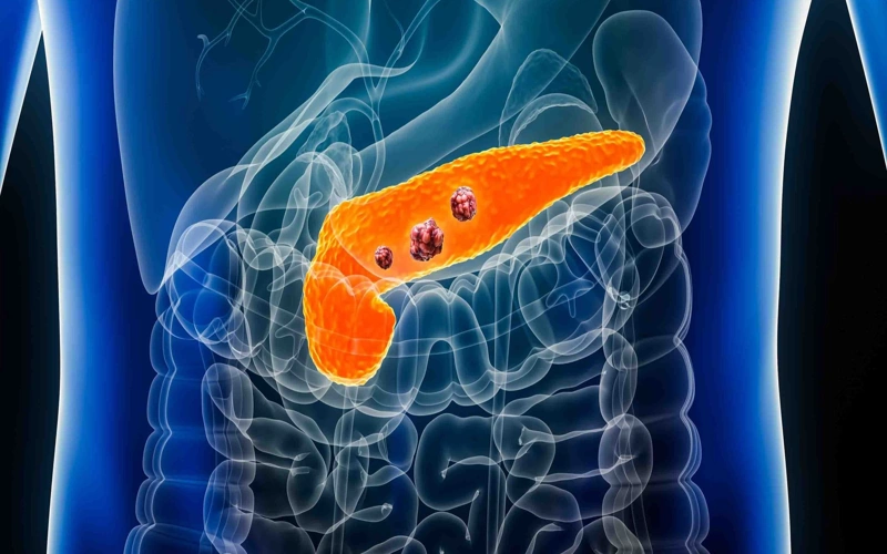 Promising US drug offers hope for pancreatic cancer patients