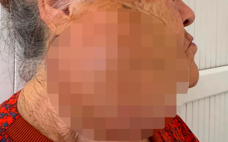 Алматы облысында 10 жыл бойы ісікпен жүрген әйелге ота жасалды 