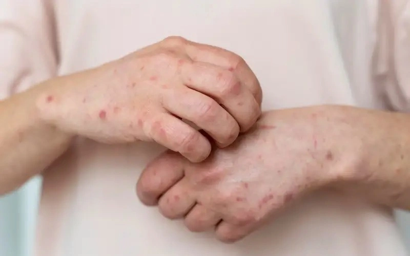 Kostanay records 16-fold increase in measles cases