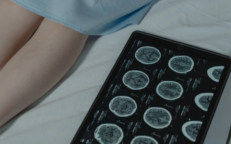 Global multiple sclerosis cases reach 3.1 Million