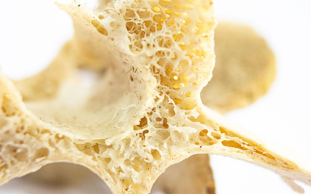 Lower bone mineral density associated with accelerated brain aging