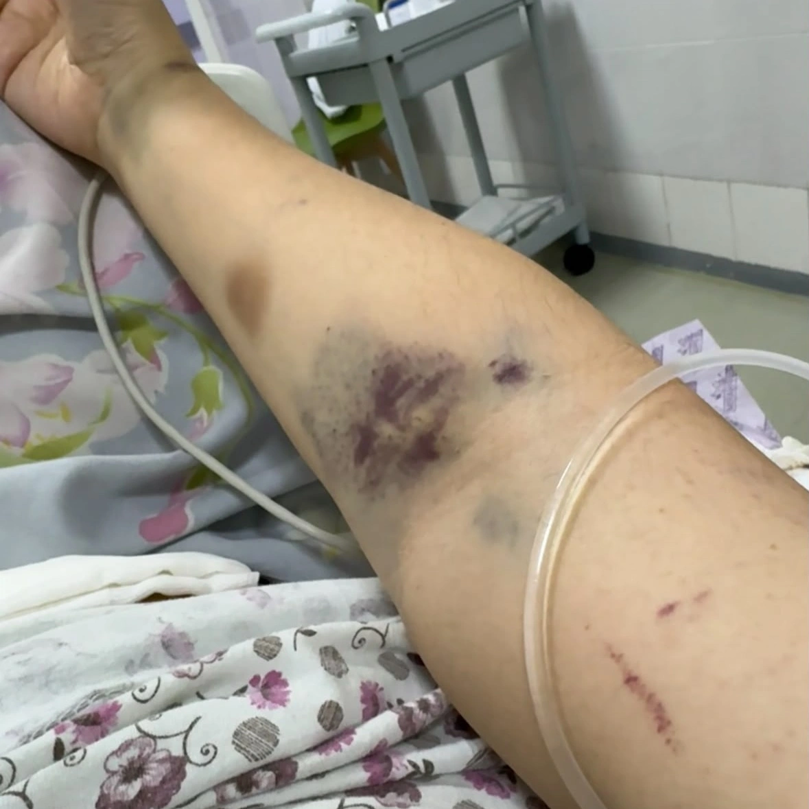 Қуығы тесіліп, жатырынан айырылған: қызылордалық ана дәрігерлердің жауап беруін талап етті